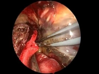 Beyin Tümörü Ameliyatı Riskleri ve Sonrası