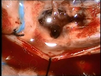 İyi Huylu Tümör Ameliyatı Riskleri ve Sonrası