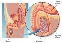 Testis Tümörü Belirtileri ve Tedavisi