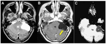 Başta Tümör Belirtileri Nelerdir?