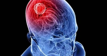 Beyin Tümörü Belirtileri ve Tedavisi