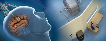 Beyin Tümörü Ameliyatı Riskleri Nelerdir?