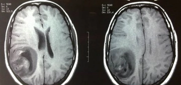 Beyinde İyi Huylu Tümör Belirtileri ve Tedavisi