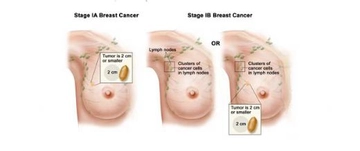 Göğüste Tümör Belirtileri ve Tedavisi