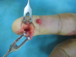 Parmakta Tümör Belirtileri ve Tedavisi