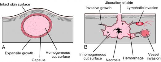 benign-tumor